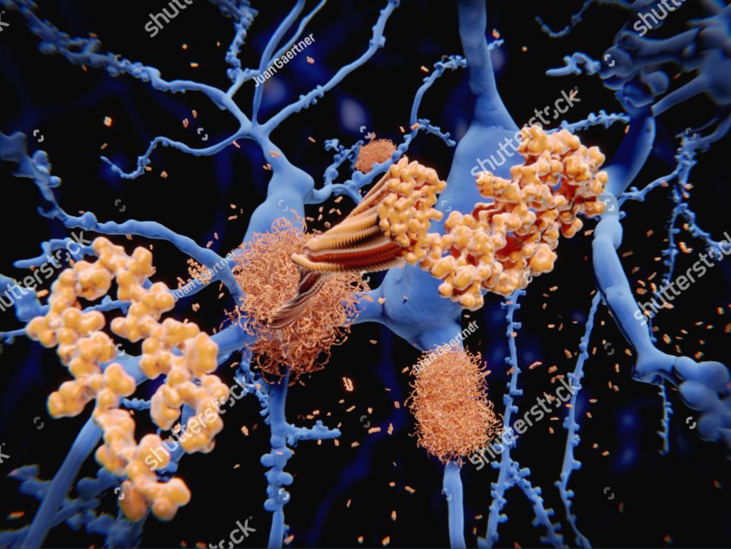 stock-photo-alzheimer-s-disease-the-amyloid-beta-peptide-accumulates-to-amyloid-fibrils-that-build-up-dense-1157052994 stock-photo-alzheimer-s-disease-the-amyloid-beta-peptide-accumulates-to-amyloid-fibrils-that-build-up-dense-1157052994